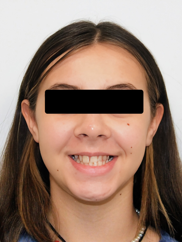 Before braces treatment by Miami orthodontist Dr. Martinez for patient S.P. presenting with a Class III malocclusion and narrow maxilla.