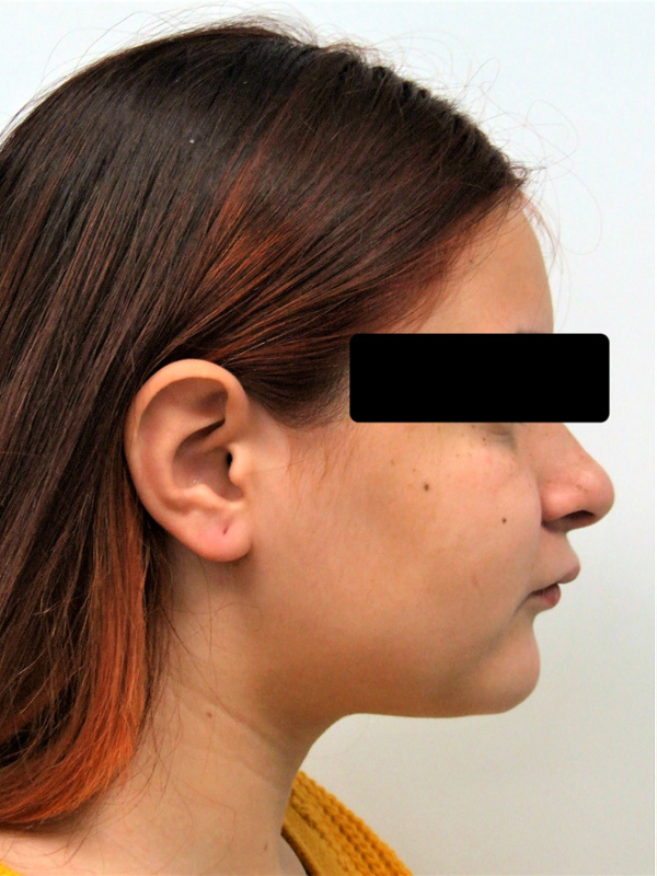 Significant overjet profile view before braces and Herbst appliance treatment in Kendall.