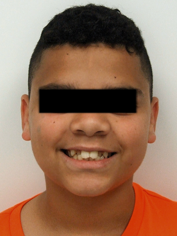 Adolescent patient before severe crowding and crossbite treatment by Kendall orthodontist.