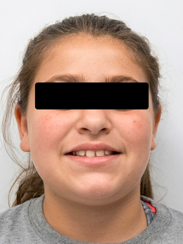 Full-face view of a preteen with a narrow maxilla and dental spacing prior to comprehensive orthodontic care in Miami.