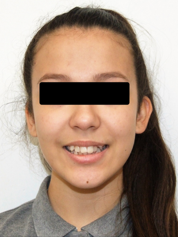 Portrait of a teenage patient with severe dental crowding and shifted midlines before comprehensive orthodontic treatment in Miami