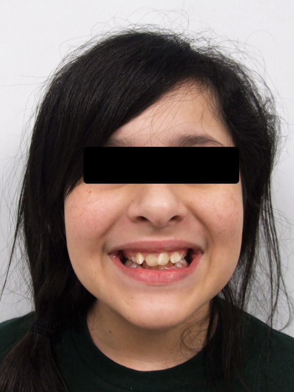 Full-face view of a preteen female with a Class II Division 2 malocclusion and a gummy smile before orthodontic treatment in Miami.