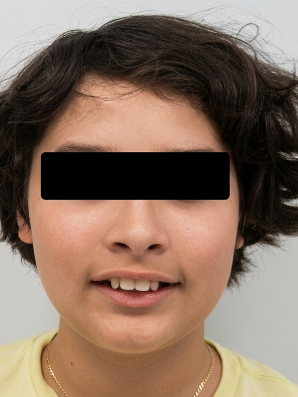 Patient portrait showing severe dental protrusion and profile before treatment in Kendall.