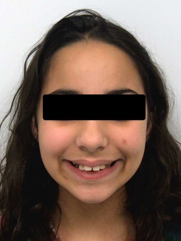 Retrato frontal de paciente preadolescente mostrando paladar estrecho, espacios y protrusión antes del tratamiento con frenillos y expansión en Martinez Orthodontics Miami.