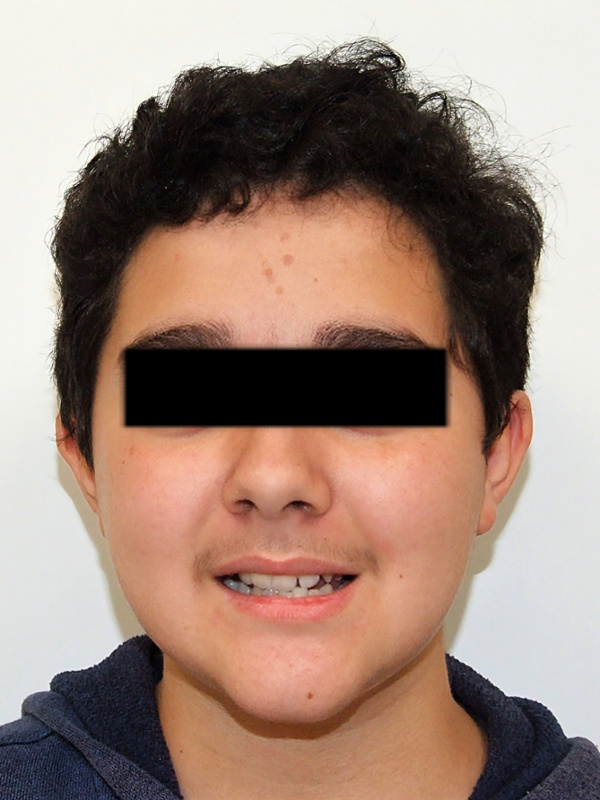 Frontal portrait of a patient showing a blocked-out upper canine and severe dental crowding before traditional metal braces at Martinez Orthodontics Miami.