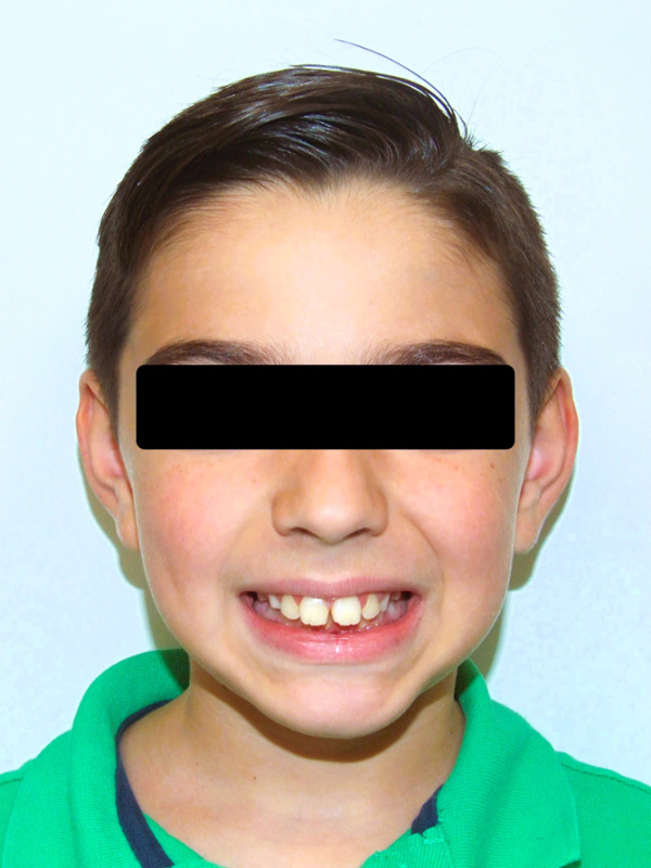 Profile view of a preteen with a retrognathic jaw and severe overjet prior to growth-coordinated orthodontics in Miami.