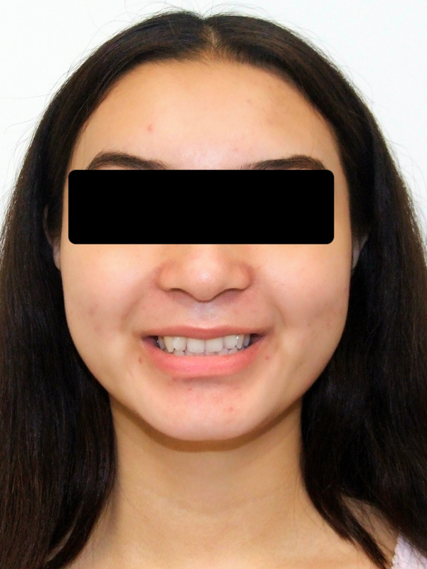 Initial dental crowding and overlapping teeth in an adult patient before orthodontic treatment in Kendall.