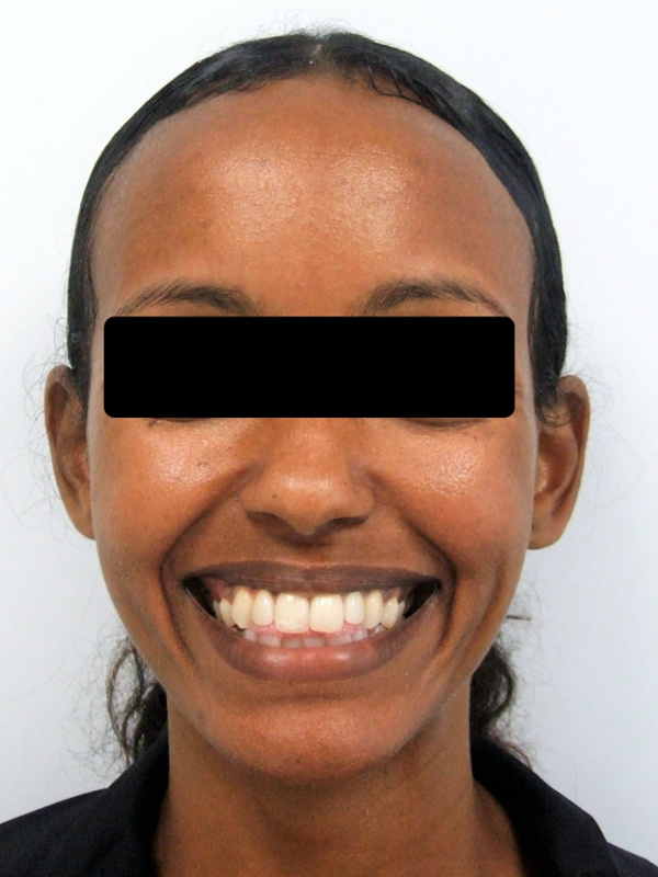 Clinical portrait of an adult female featuring a pronounced anterior open bite and dental misalignment prior to treatment.