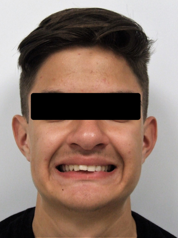 Frontal portrait of a teen patient displaying severe dental protrusion before traditional braces treatment at Martinez Orthodontics Miami.