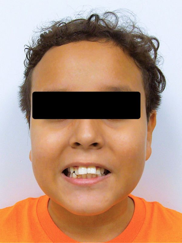 Portrait of a preteen patient with severe overjet protrusion and moderate crowding before traditional metal braces in Miami