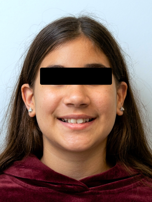 Frontal portrait of a preteen patient displaying a narrow smile and crowding before expansion and braces treatment at Martinez Orthodontics Miami.
