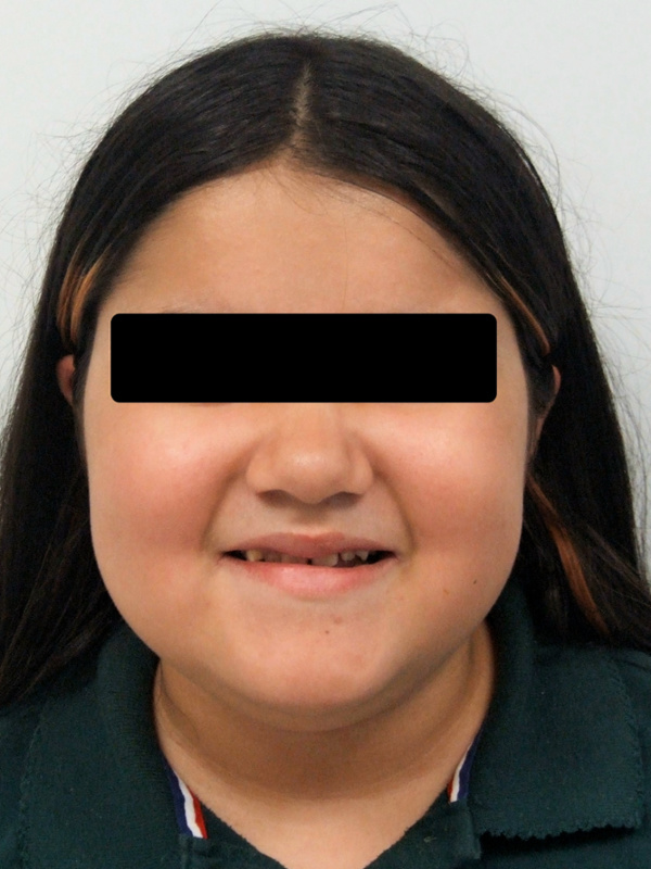 Portrait of a preteen patient with an anterior crossbite underbite before Phase I early orthodontic treatment in Miami