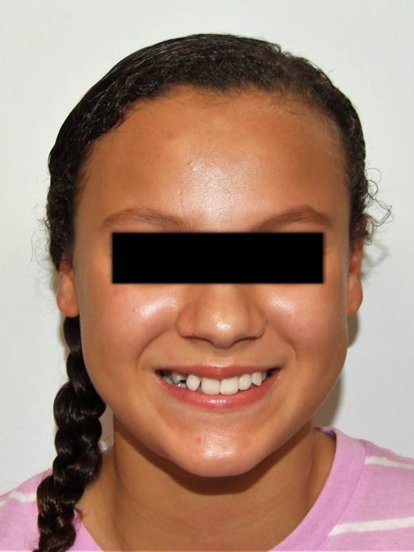Full-face view of a teenager with an impacted canine prior to multidisciplinary orthodontic and surgical care in Miami.