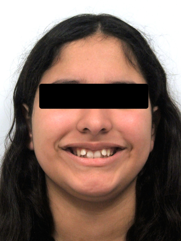 Portrait of a teenager with a deep bite before starting orthodontic care in Miami.
