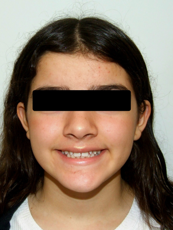Portrait of a teenager smiling, featuring visible spaces between their teeth prior to orthodontic care.
