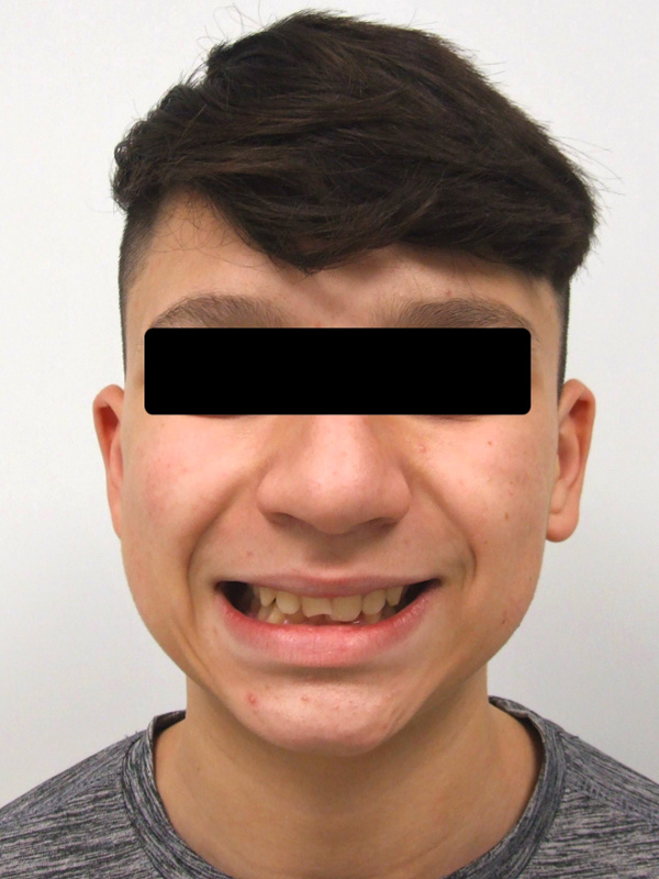 Portrait of a teenage patient with a recessed lower jaw and severe overjet before comprehensive orthodontic treatment in Miami.