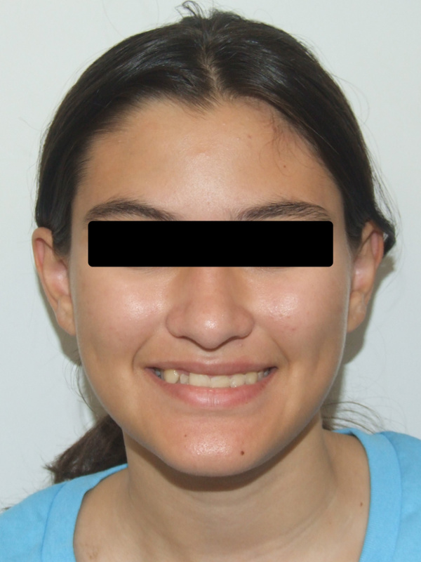 Full clinical portrait of a student featuring significant dental crowding before orthodontic care.