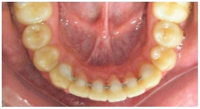 Clear-Aligners-Fixed-retainer-After-Image