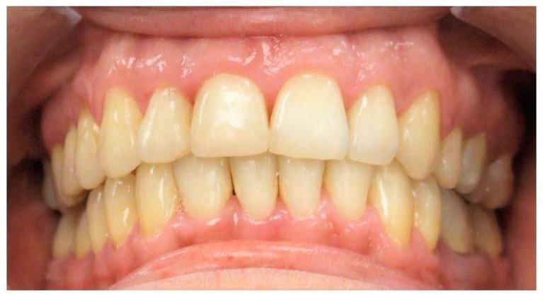 Traditional-Metal-Braces-in-Adult-Dentition-After-Image