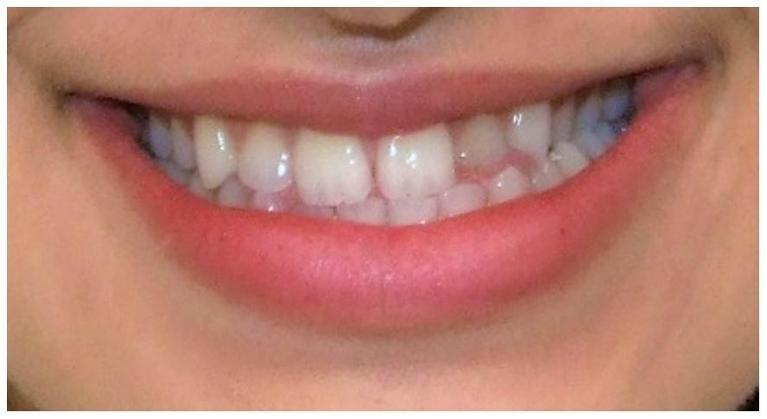 Mandibular prognathism: Large lower jaw and Underbite 