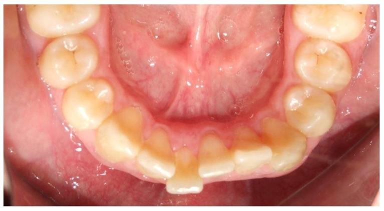 Clear-Aligners-Fixed-retainer-Before-Image