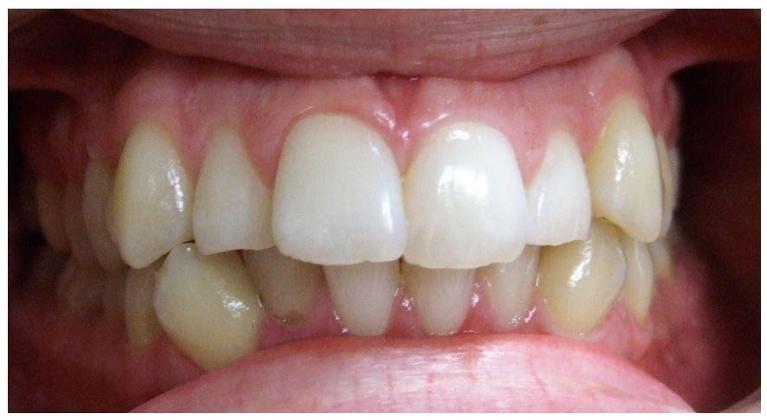 Traditional-Clear-Braces-Fixed-lower-retainer-Before-Image