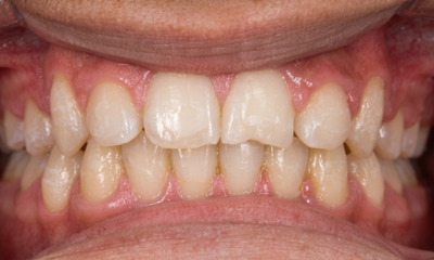 Expanded palate and aligned smile after 24-month non-extraction treatment by Miami orthodontist.
