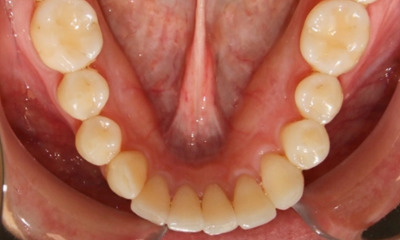 Beautifully aligned adult smile after 18 months of traditional braces in The Crossings. 