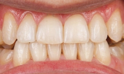 Adult expansion and braces results showing corrected arch width and aligned midlines in Kendall.