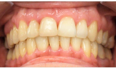 Adult-Protrusion-and-Midline-Correction-in-Miami-After-Image