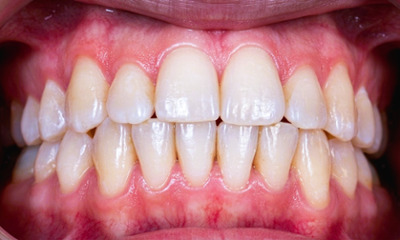 Straight teeth after braces: Adult orthodontic results in Miami.