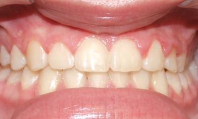 Stable smile with closed diastemas and corrected bite after braces and post-orthodontic frenectomy in Kendall.