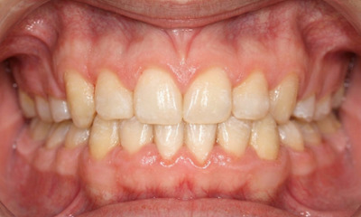 Aligned upper canine and corrected bite function following 24 months of metal braces at Martinez Orthodontics.