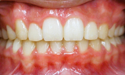 Balanced smile and corrected overbite following orthodontic treatment at Martinez Orthodontics.