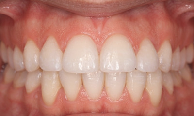 Successfully aligned teeth and a healthy smile after orthodontic treatment. 