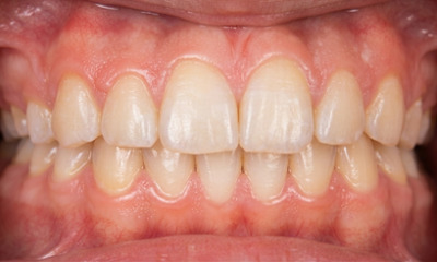 Aligned front teeth after orthodontic treatment at Martinez Orthodontics.