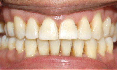 Final stable and functional bite structurally optimized for restorative dental implants after multidisciplinary orthodontics in Kendall. 