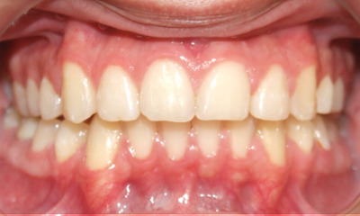 Aligned smile and corrected bite function following 24 months of orthodontic treatment at Martinez Orthodontics.