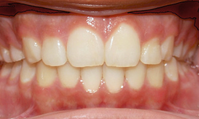 Beautifully aligned preteen smile with corrected overjet and safely retracted front teeth after metal braces by Kendall Orthodontist.