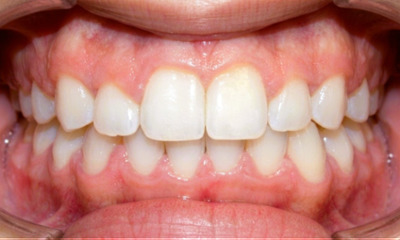 Broad, aligned smile with closed spaces and a corrected bite after 30 months of metal braces and rubber bands treatment in Kendall.