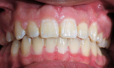 Successful alignment and crowding resolution following metal braces and premolar extractions at Martinez Orthodontics.