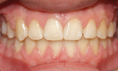 Close-up of the teen’s smile after completing treatment with traditional braces, showing the front gap completely closed, a corrected bite, and perfectly centered midline alignment.