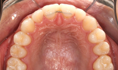 Upper dental arch photo showing beautifully aligned teeth with all gaps completely closed and secured with a fixed retainer.