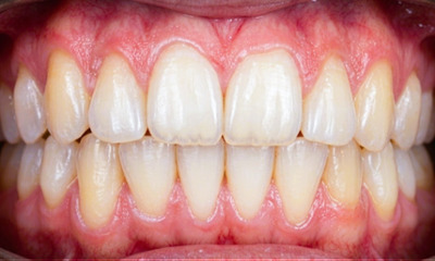 Properly aligned teen smile with corrected bite and canine after metal braces by Kendall Orthodontist.