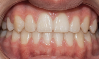 Underbite-and-Jaw-Shift-Correction-in-Miami-After-Image