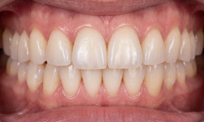 Close view of a healthy, straight bite after adult orthodontic retreatment in The Hammocks.