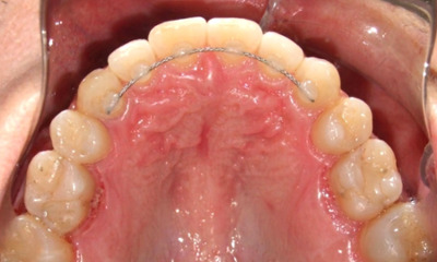 Intraoral occlusal view showing a successfully expanded maxillary arch with a permanent fixed retainer and a stable, aligned dental arch after adult RPE treatment in Kendall.