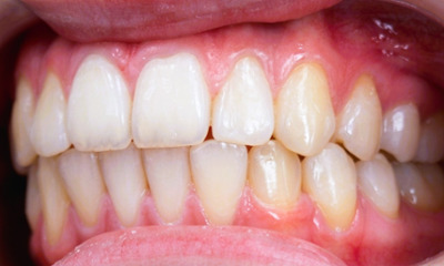 Intraoral side view showing a successfully aligned lower canine and closed posterior bite after metal braces in Kendall