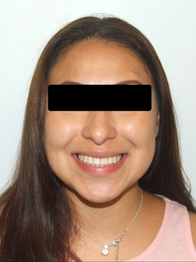 Full smile transformation after braces: Martinez Orthodontics Miami.