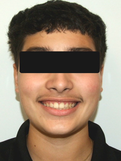 Patient portrait showing a balanced profile and corrected alignment after Herbst appliance treatment.